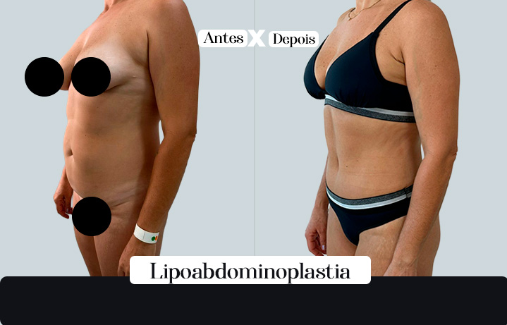 Lipo+Abdominoplastia 01