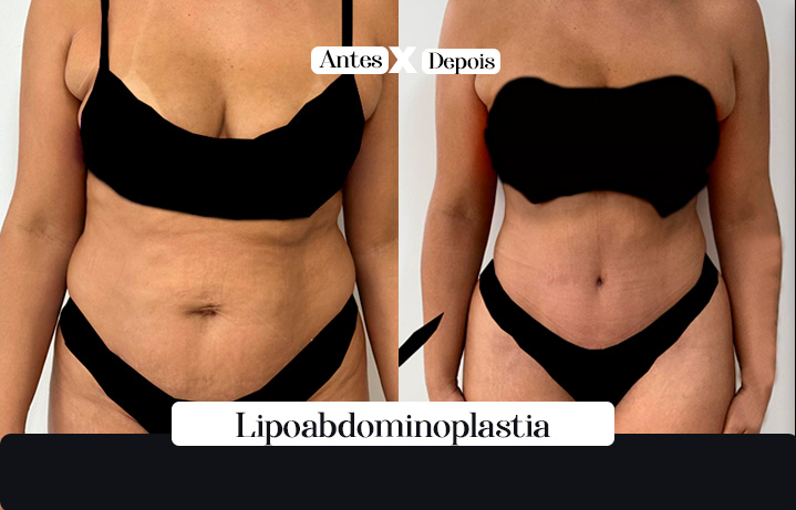 Lipo+Abdominoplastia 03