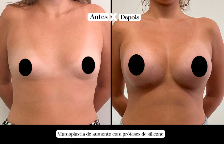 proteses copiar 3