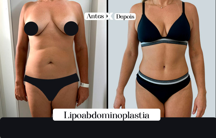 Lipo+Abdominoplastia 02