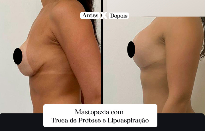 MastoPexia 02