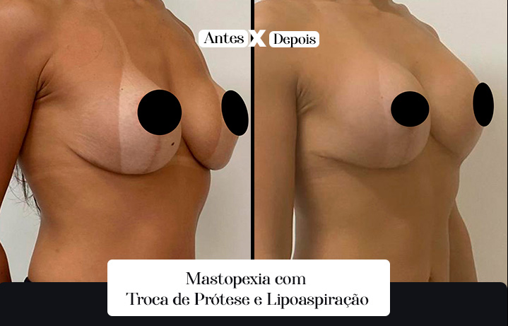 MastoPexia 03